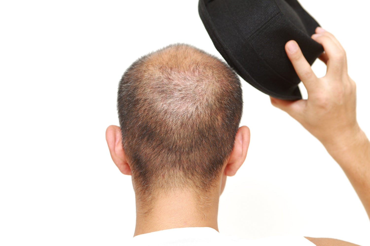 Does Wearing a Hat Make You Lose Hair?